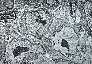 M, 80y. | mycosis fungoides M, 80y. | mycosis fungoides